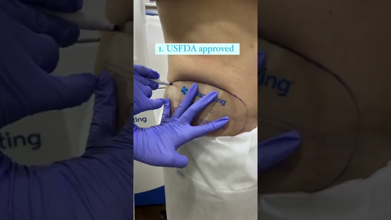 Say goodbye to love handles with Coolsculpting
