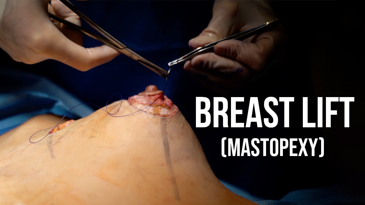 Breast Lift (Mastopexy) - Dr. Paul Ruff | West End Plastic Surgery