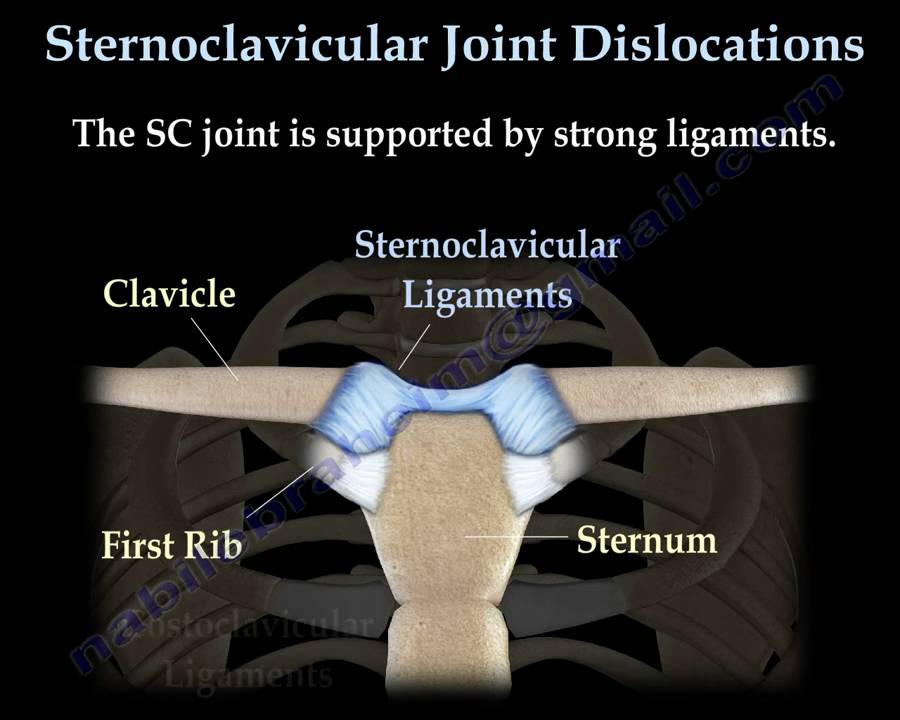 Sternoclavicular  joint Dislocations - Everything You Need To Know - Dr. Nabil Ebraheim