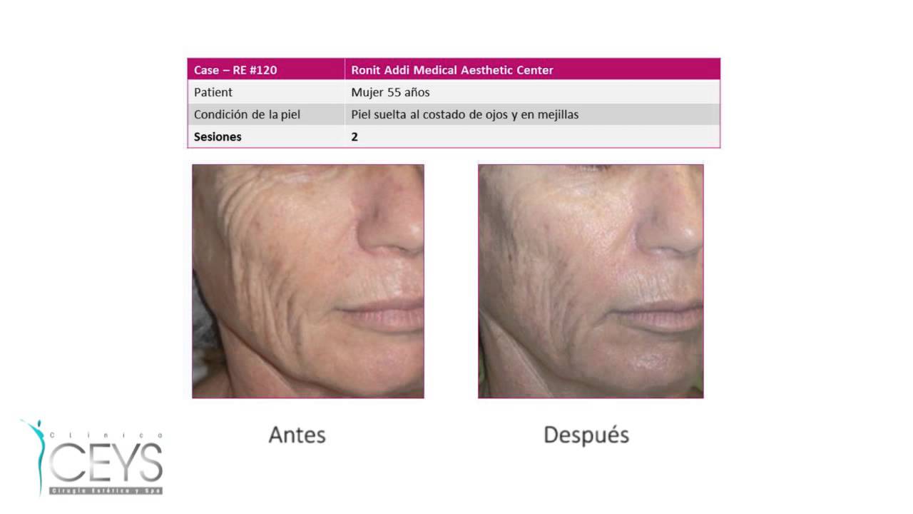 Antes/Después Radiofrecuencia Reaction