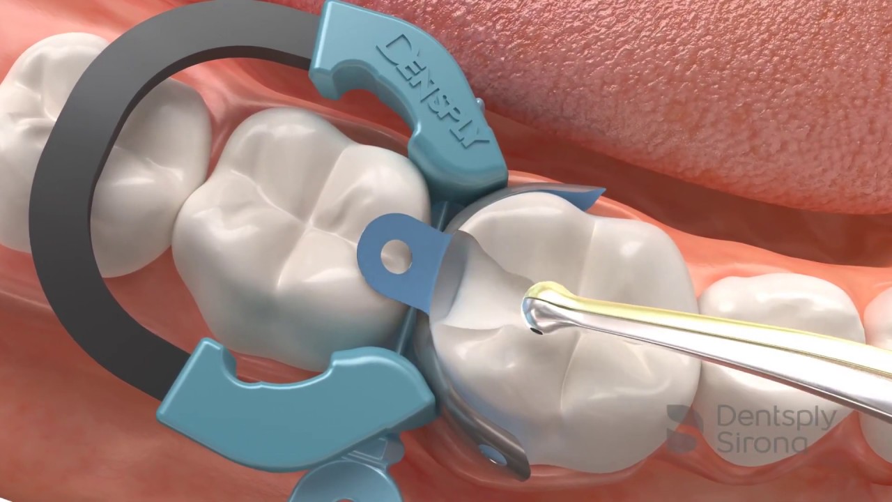 Palodent V3 - Sectional Matrix System