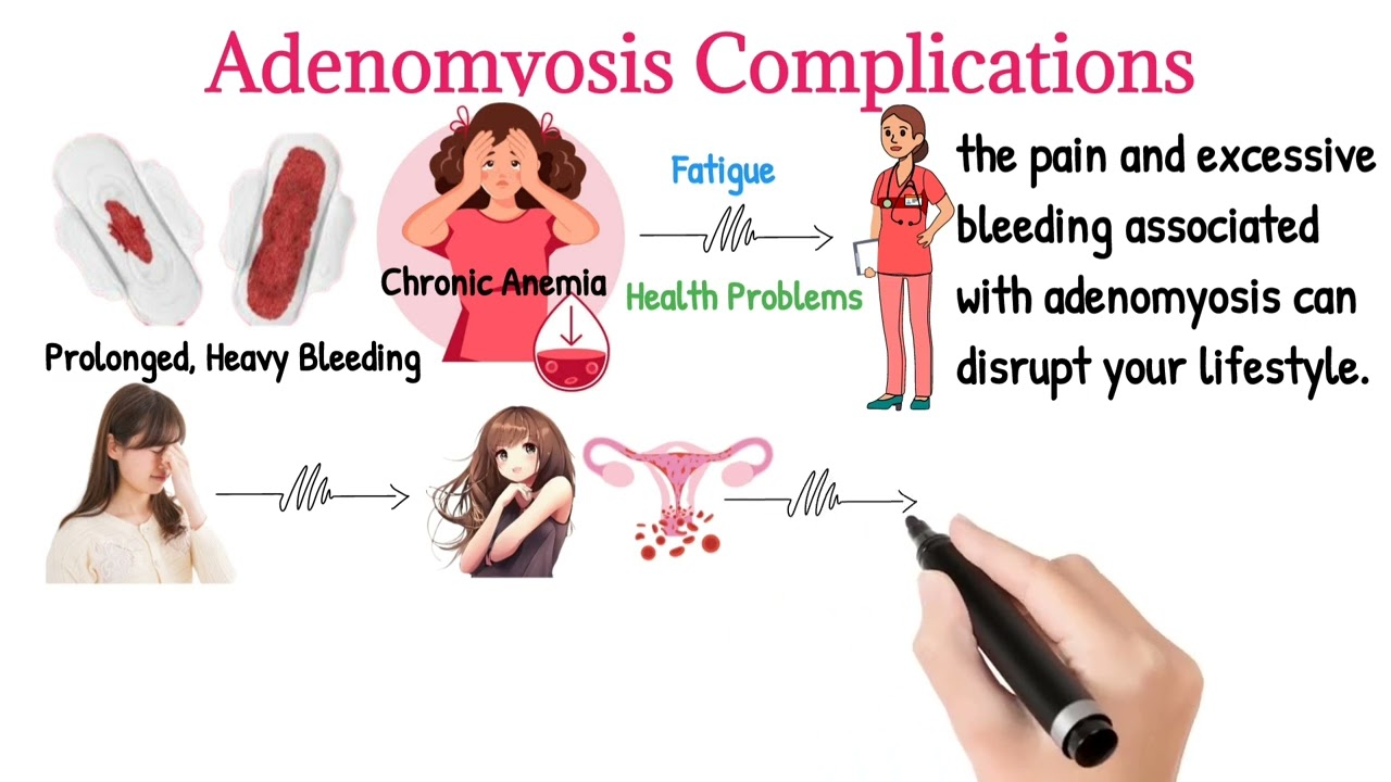 What Are Adenomyosis Complications? | Medidoc
