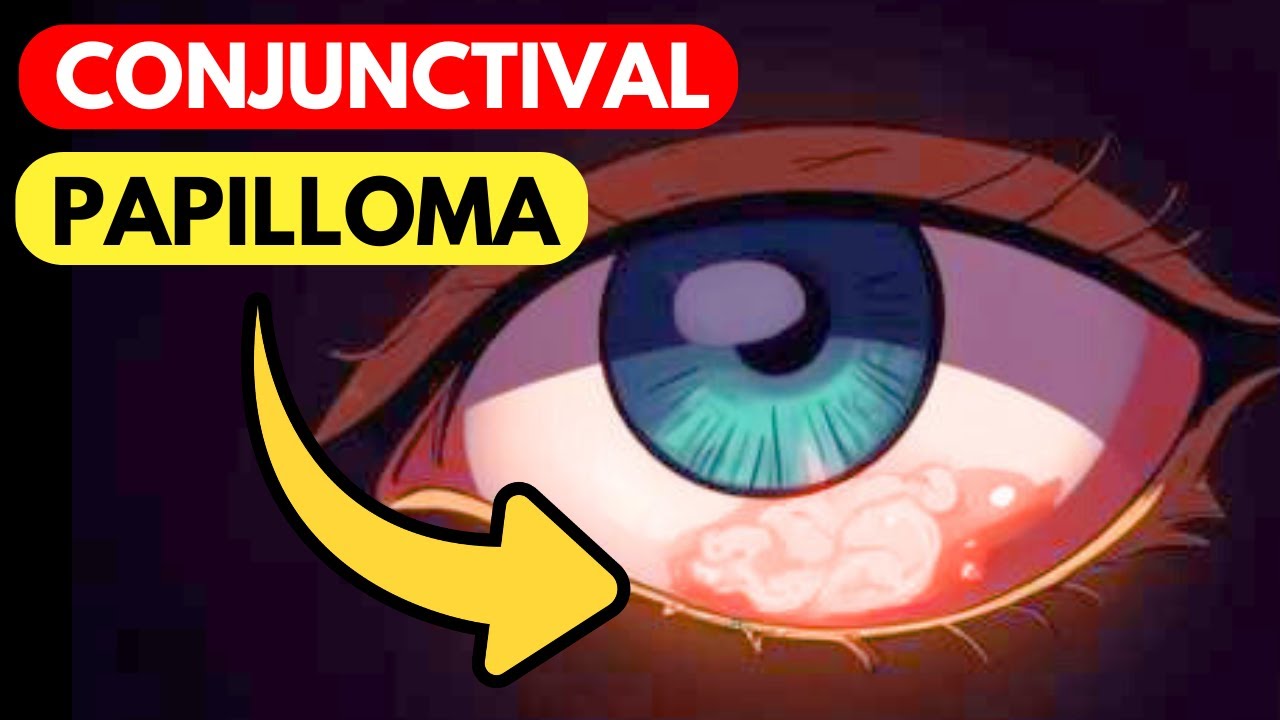 Is That Bump on Your Eye Dangerous? Conjunctival Papilloma Explained