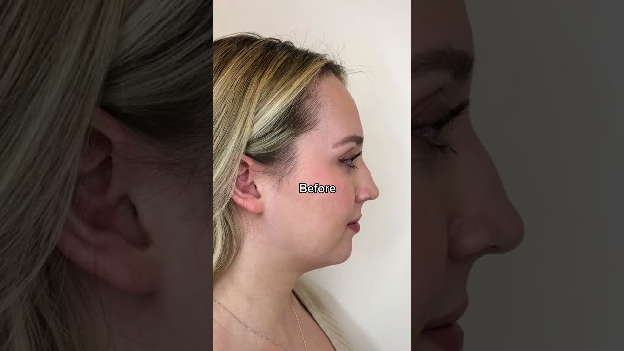 I got 3 Belkyra treatments to treat my #doublechin & these are the results!#beforeandafter #kybella