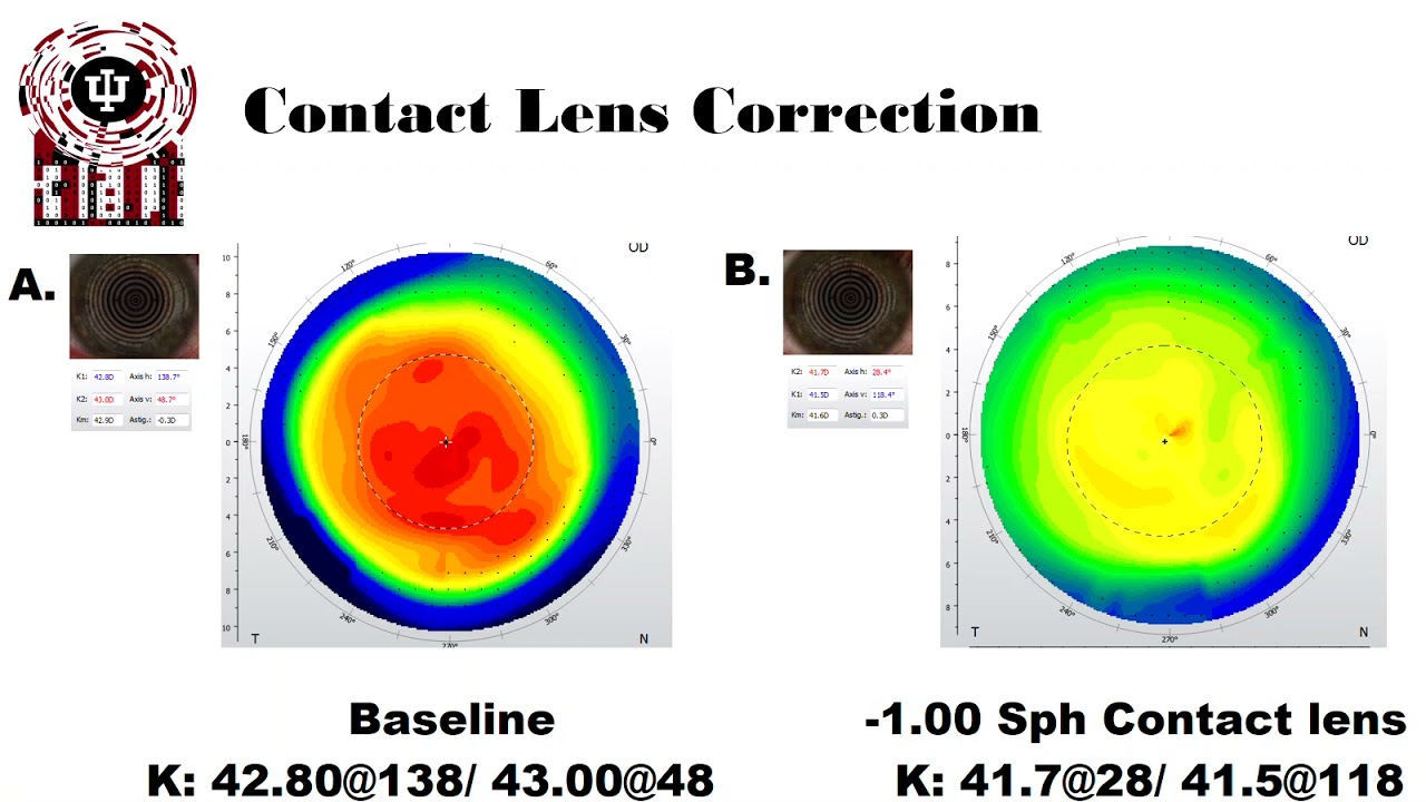 Anisometropia and Aniseikonia Treatment