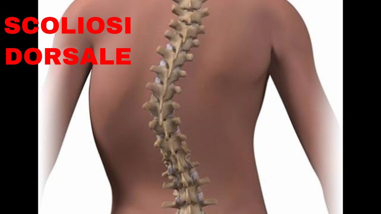 Scoliosi dorsale: esercizio terapeutico.