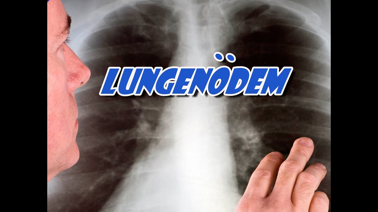 Lungenödem | Erkrankungen der Atemwege | Pflege Kanal