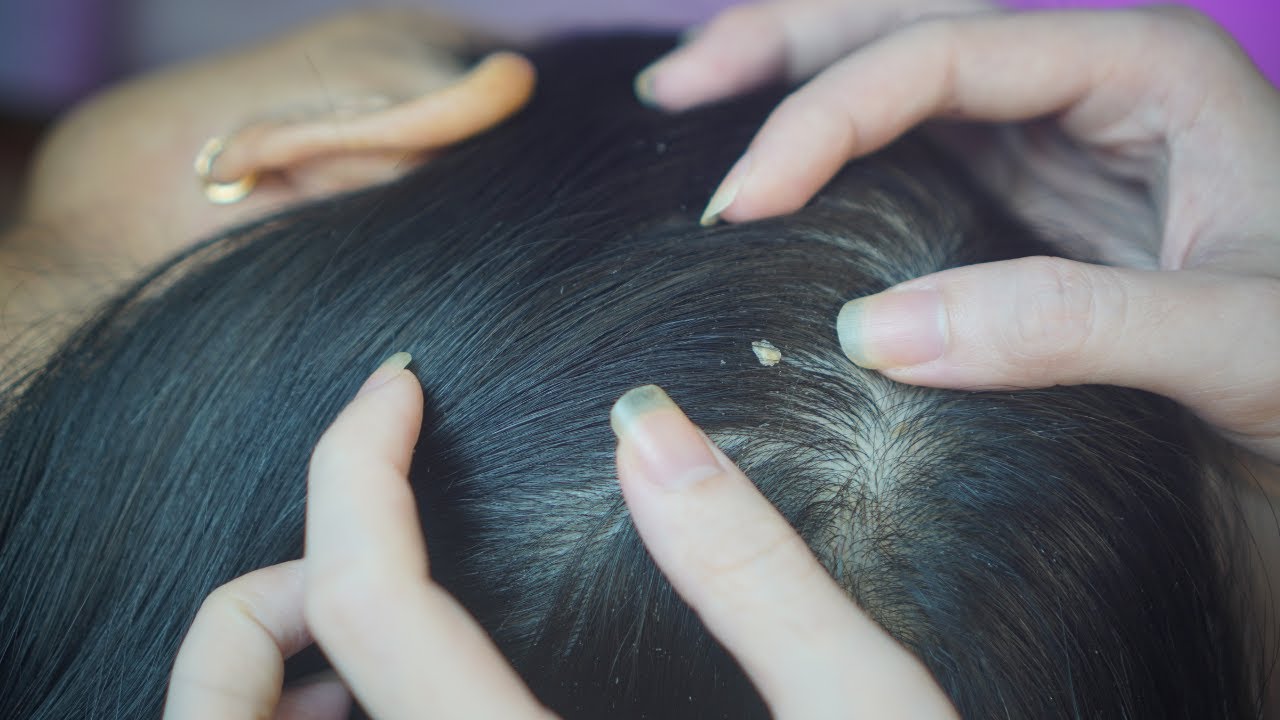 ASMR Scalp Scratchingg, Scalp Massage With Hair Parting Sounds | Tingly Scalp Triggers