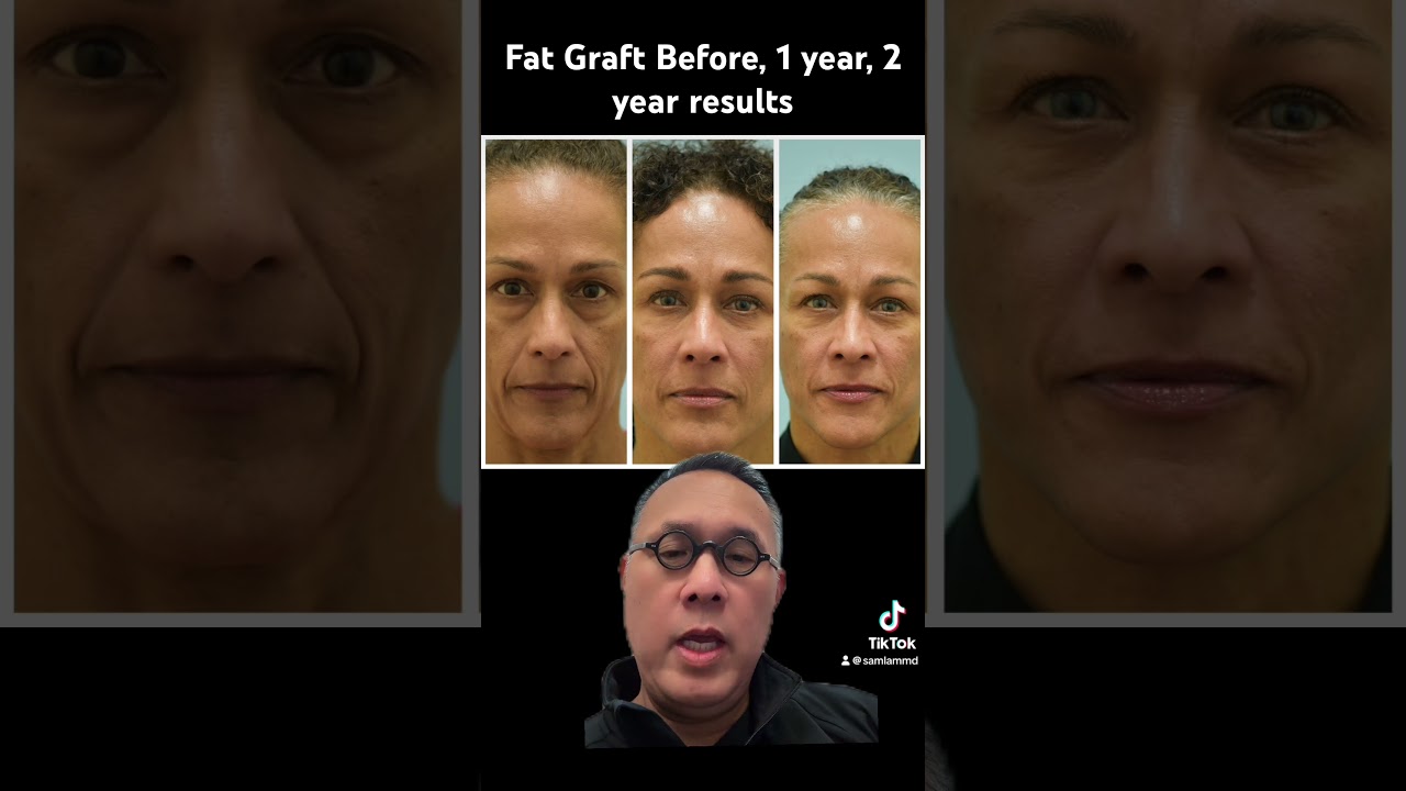 Fat Graft Before, 1 year, 2 year results with discussion