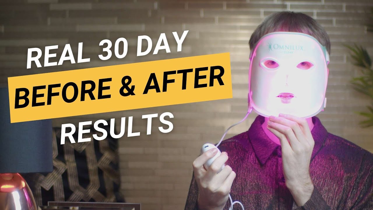 Red & Blue Light Therapy for Acne | 30 Day Before and After Results