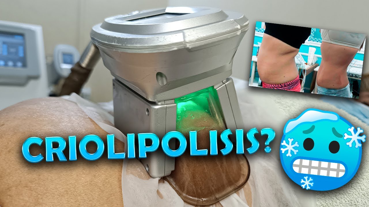 CRIOLIPOLISIS - COOLSCULPING  que es? Como funciona? Resultados
