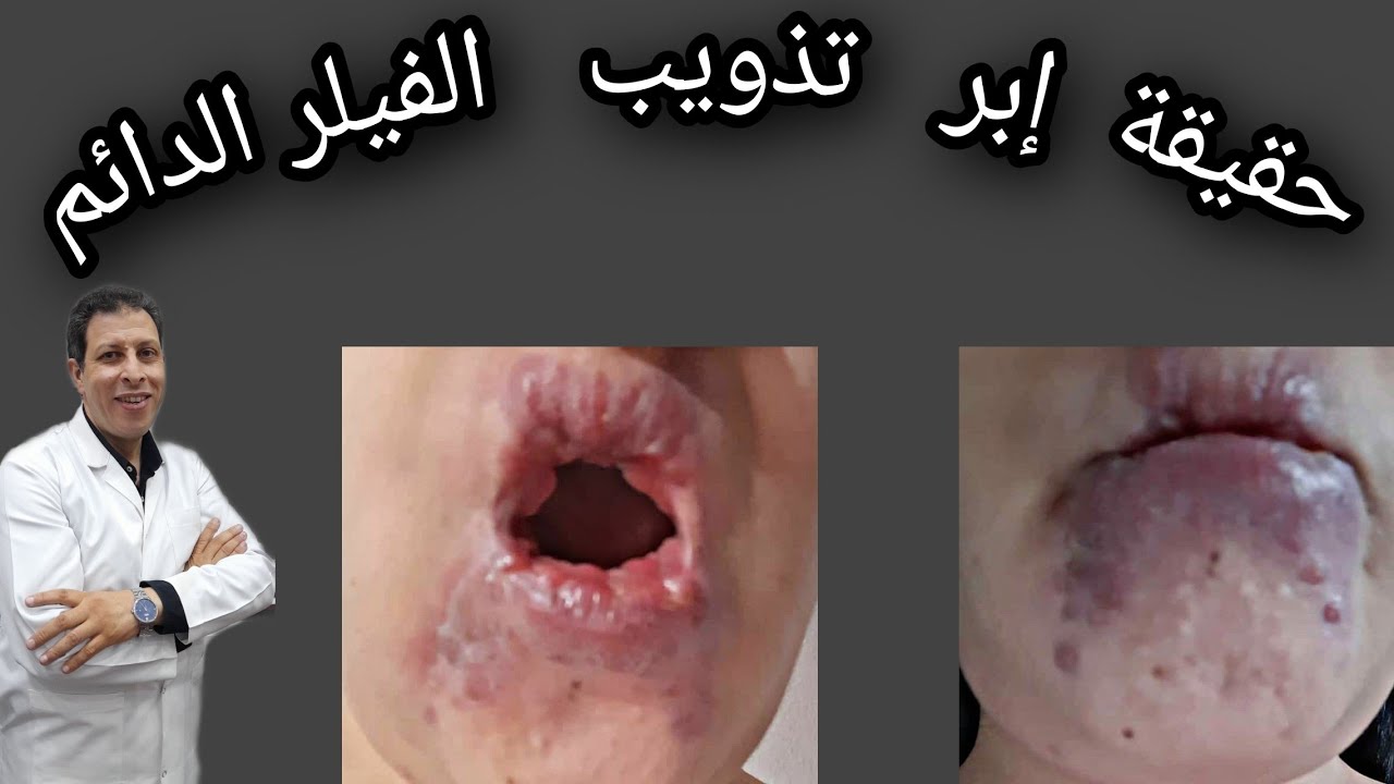 حقيقه ابر تذويب الفيلر الدائم مع دكتور ياسر الشيخ