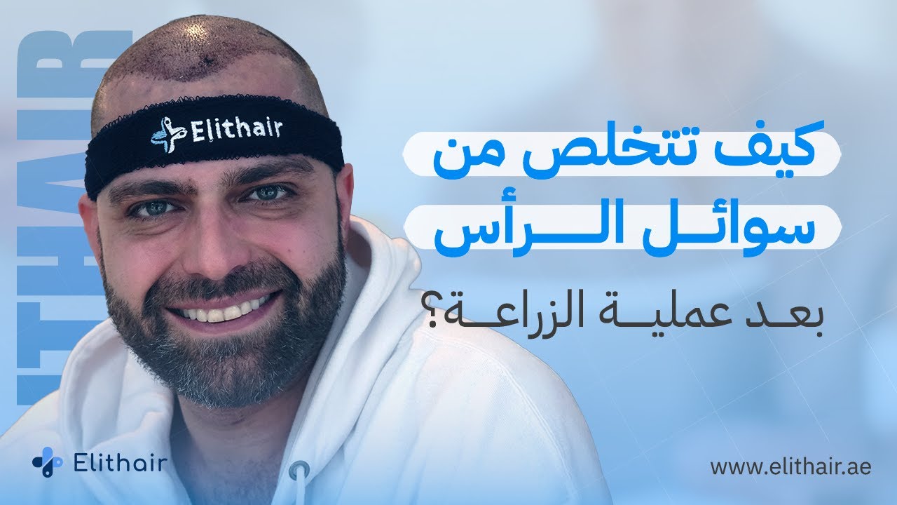 أقوى 3 نصائح للتخلص من التورم بعد زراعة الشعر