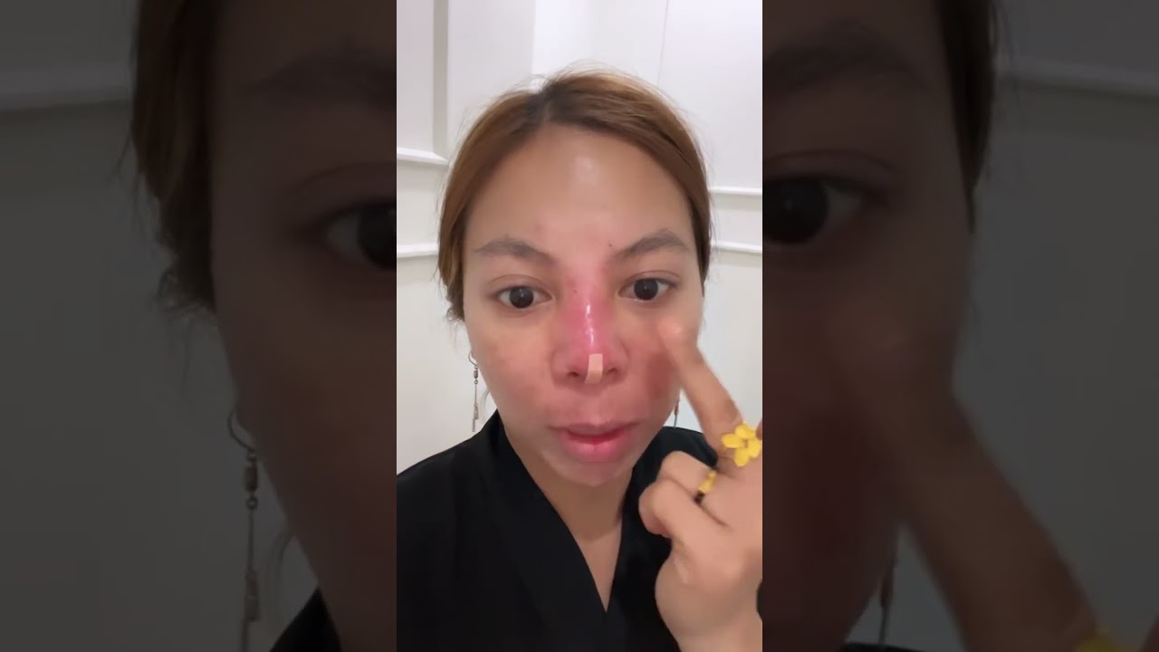 TANAM BENANG HIDUNG