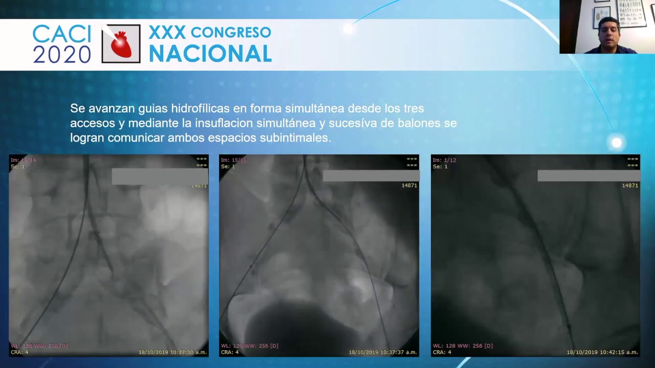Videoposter CACI 2020 | Gobelet A: Tratamiento de Leriche.