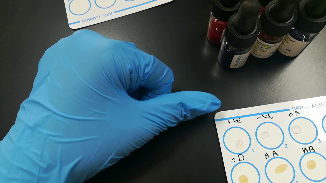 كيفية إجراء تحليل widal test، تحليل فيدال، تحليل التيفوئد