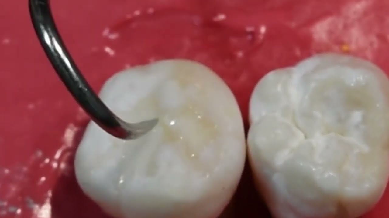 COMO HACER sellador de fosetas y fisuras PASO A PASO