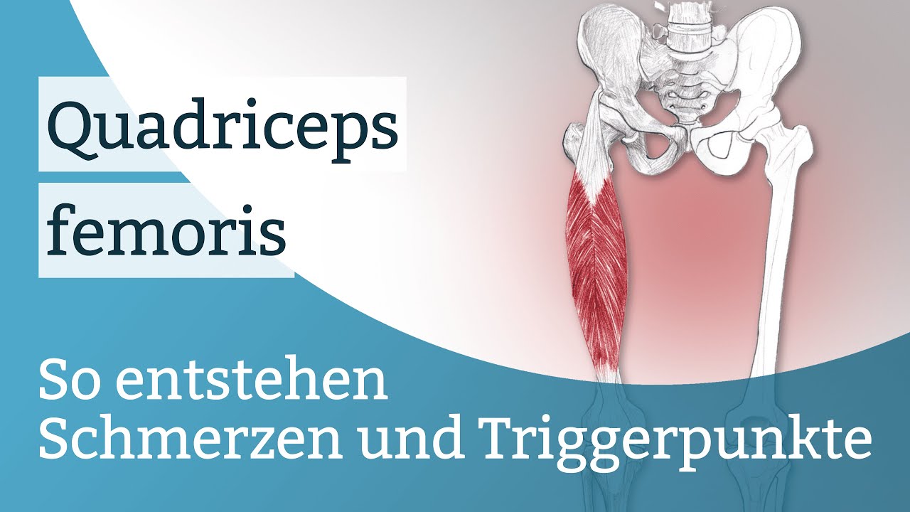 Quadriceps femoris Schmerzen, Triggerpunkte und deren Aktivierung