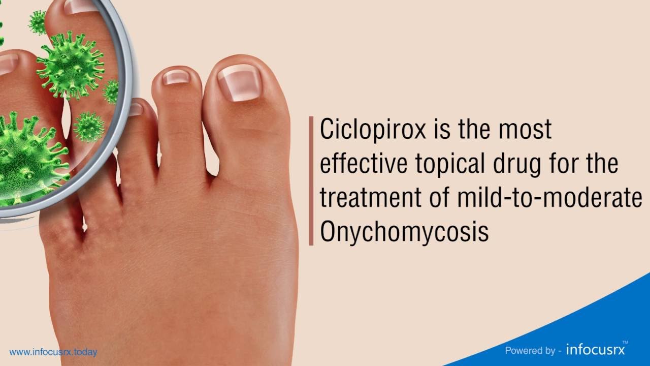 Ciclopirox is the most effective topical drug for the treatment of mild-to-moderate Onychomycosis