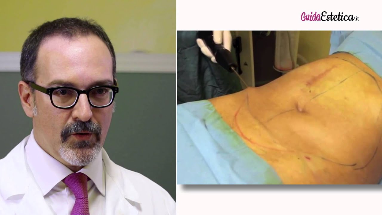 Laserlipolisi: la liposuzione del solletico per eliminare il grasso addominale