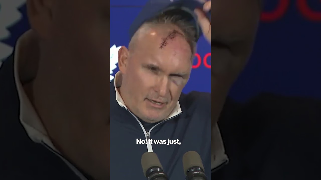 Maple Leafs coach reveals MAJOR gash on his head! #shorts