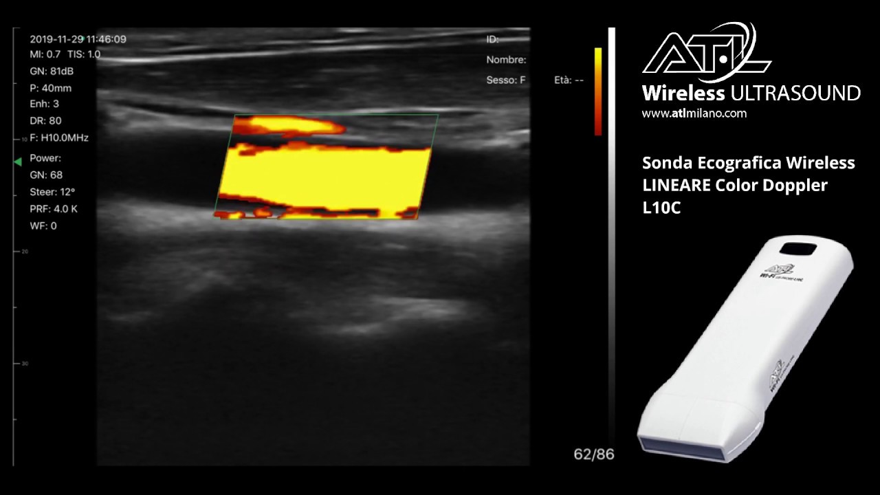 ATL Sonda ecografica wireless LINEARE