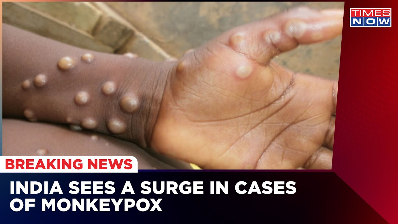 India Reports Ninth Case Of Monkeypox, Union HM Says 'All Steps Are Being Taken' | English News