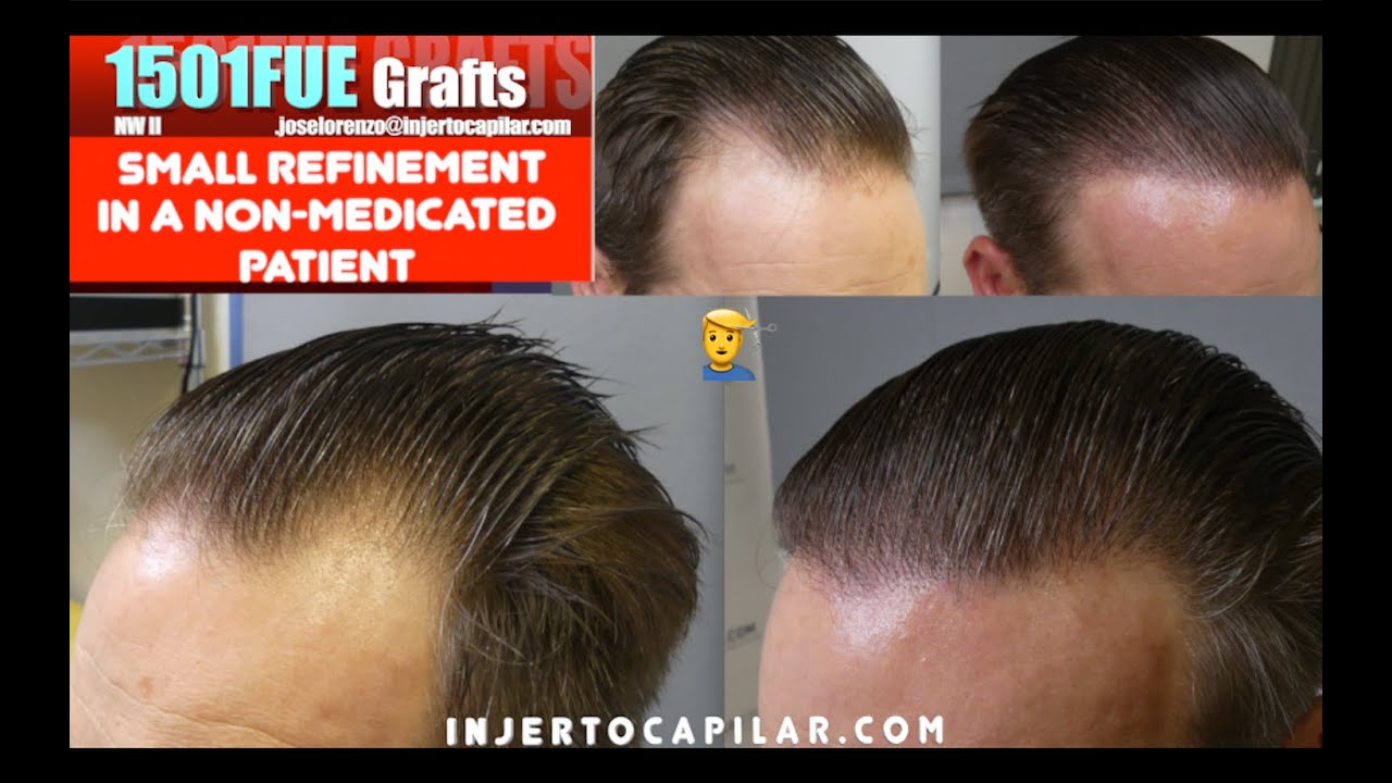 1501Grafts. MPB NW II. Small refinement in a non-medicated patient. Injertocapilar.com. 2955/2023