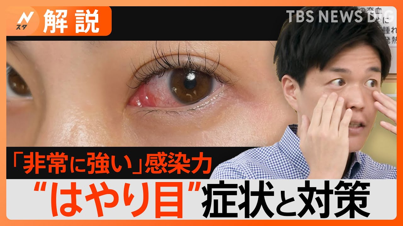 目の感染症&ldquo;はやり目&rdquo;に注意&nbsp;1か月症状が治らない大人も&hellip;家庭内の&ldquo;感染リレー&rdquo;を防ぐポイントは？【Nスタ解説】｜TBS&nbsp;NEWS&nbsp;DIG