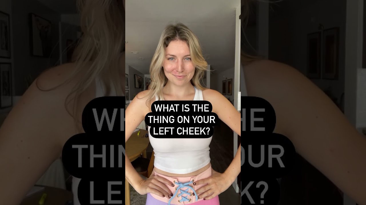Have you met someone with a PWS before? 💜🙂 #birthmark #vascular #skincondition #shorts #bodylove