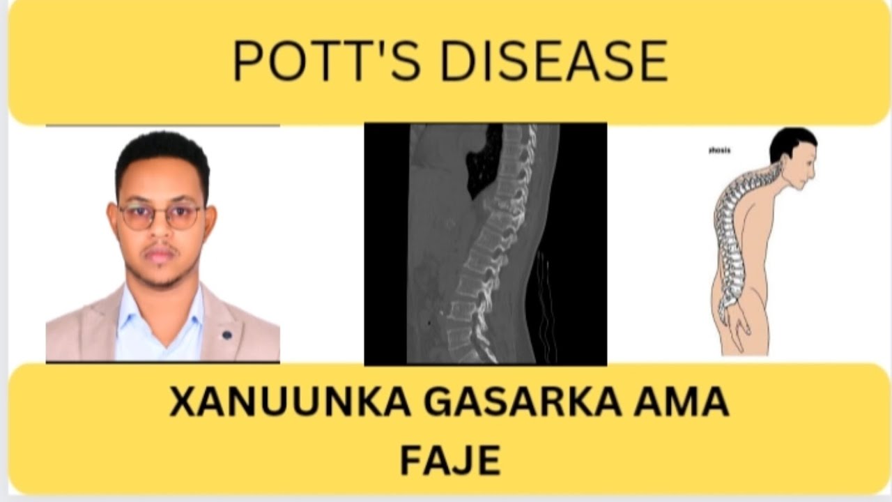 Wax ka ogow xanuunka " GASARKA " ( Pott's Disease )  Dr. Ayanle Ali Mohamoud