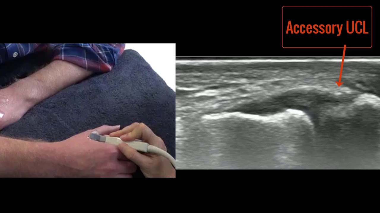 Ultrasound of the UCL of the thumb