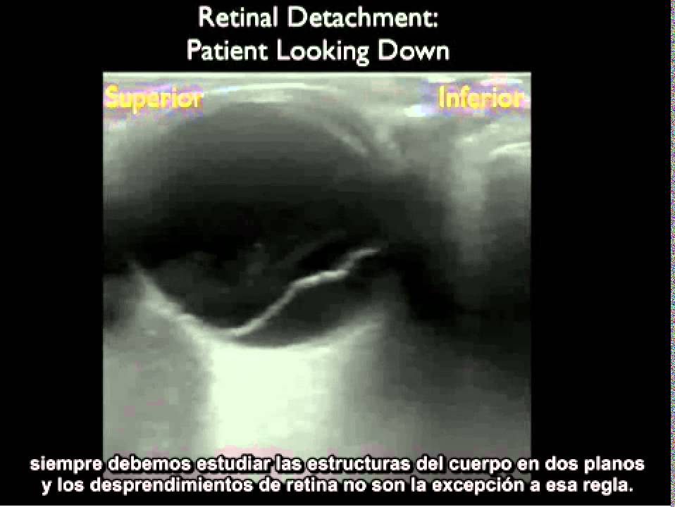 Procedimiento para realizar una ecografía ocular en un estudio de caso - Parte 2