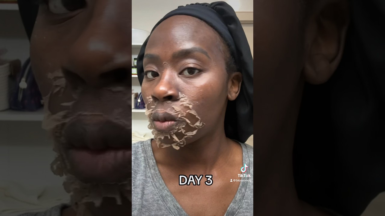 Chemical Peel Journey for black skin #chemicalpeel #skincare