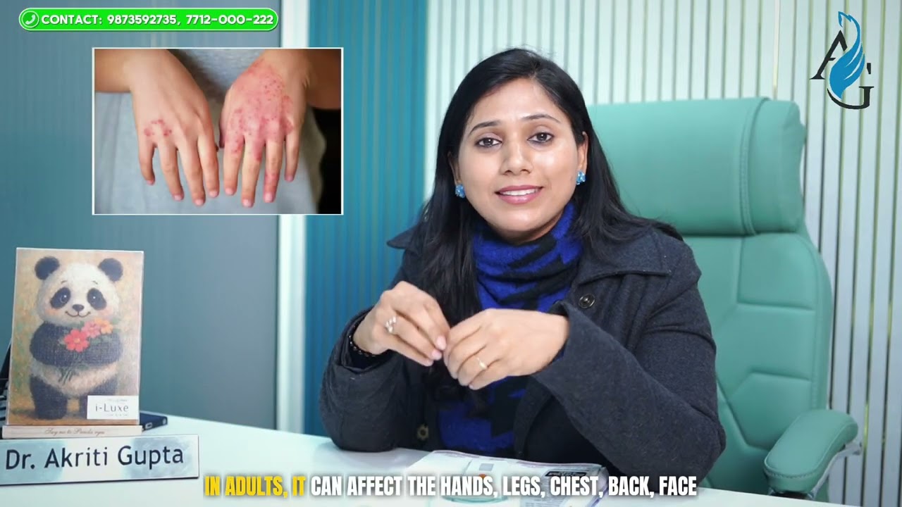 Skin पर Itching & Red Patches? हो सकता है Eczema! | What is Eczema | Dr. Akriti Gupta
