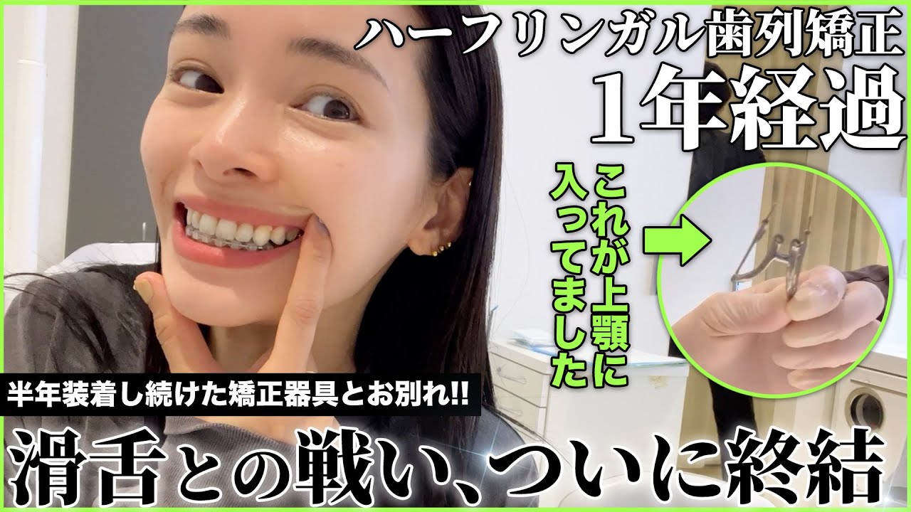 【大人の歯列矯正】遂に滑舌が元に戻る日がやってきた.....!?【抜歯箇所埋まりました】