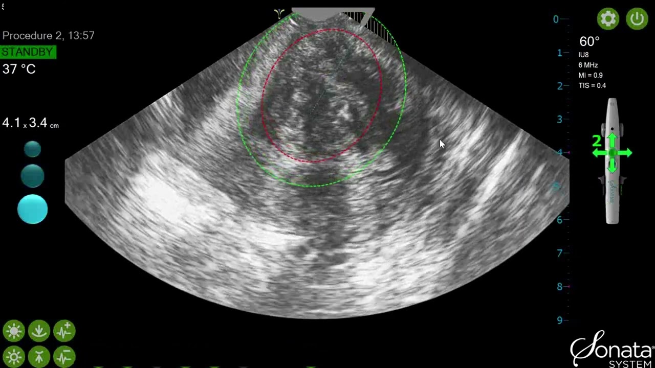 Sonata Procedure - Single Ablation of an Intramural Fibroid