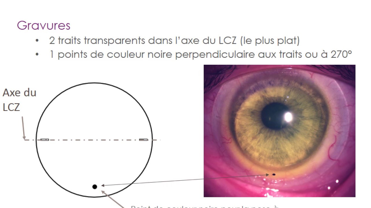 ICD HD TORIC