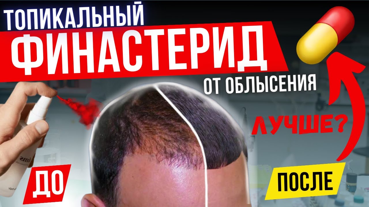 АЛЬТЕРНАТИВА ТАБЛЕТКАМ? ЖИДКИЙ  ФИНАСТЕРИД ЛУЧШЕ? ЖИДКИЕ ФОРМЫ АНТИАНДРОГЕНОВ