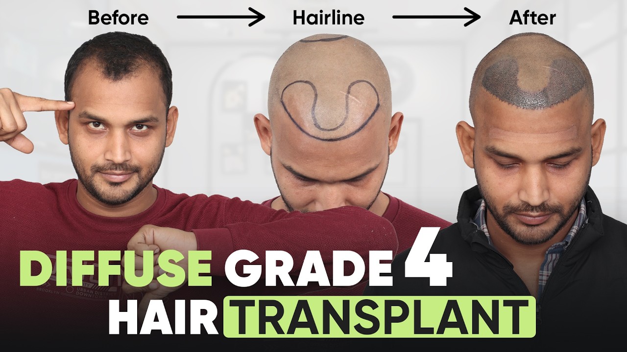 Hair Transplant in Raipur (HX-TYUI) | Best Results & Cost of Hair Transplant in Raipur