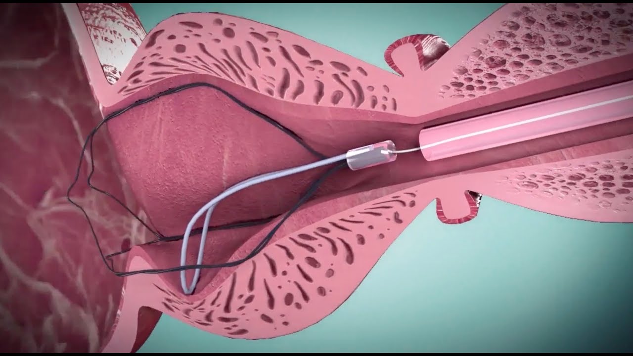 I-TIND procedure 3D animation by Medi-Tate