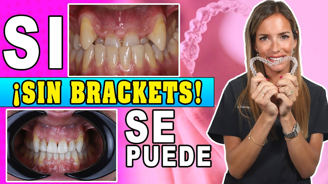 🤷🏼‍♀️¿Quieres 𝗘𝗡𝗗𝗘𝗥𝗘𝗭𝗔𝗥 los dientes 𝗦𝗜𝗡 𝗕𝗥𝗔𝗖𝗞𝗘𝗧𝗦? 👉Como Funcionan los 𝗔𝗟𝗜𝗡𝗘𝗔𝗗𝗢𝗥𝗘𝗦 𝗜𝗡𝗩𝗜𝗦𝗜𝗕𝗟𝗘𝗦