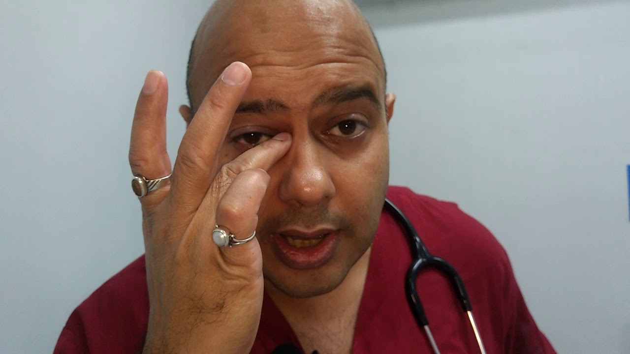 Sticky Eyes, yellowish secretion in eyes of new born | Nasolacrimal Duct block |