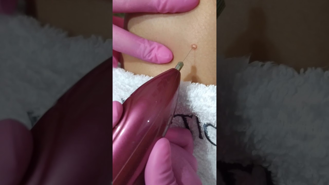 verrugas! Remoção com jato de Plasma! Visite meu insta! yu_ esteticista