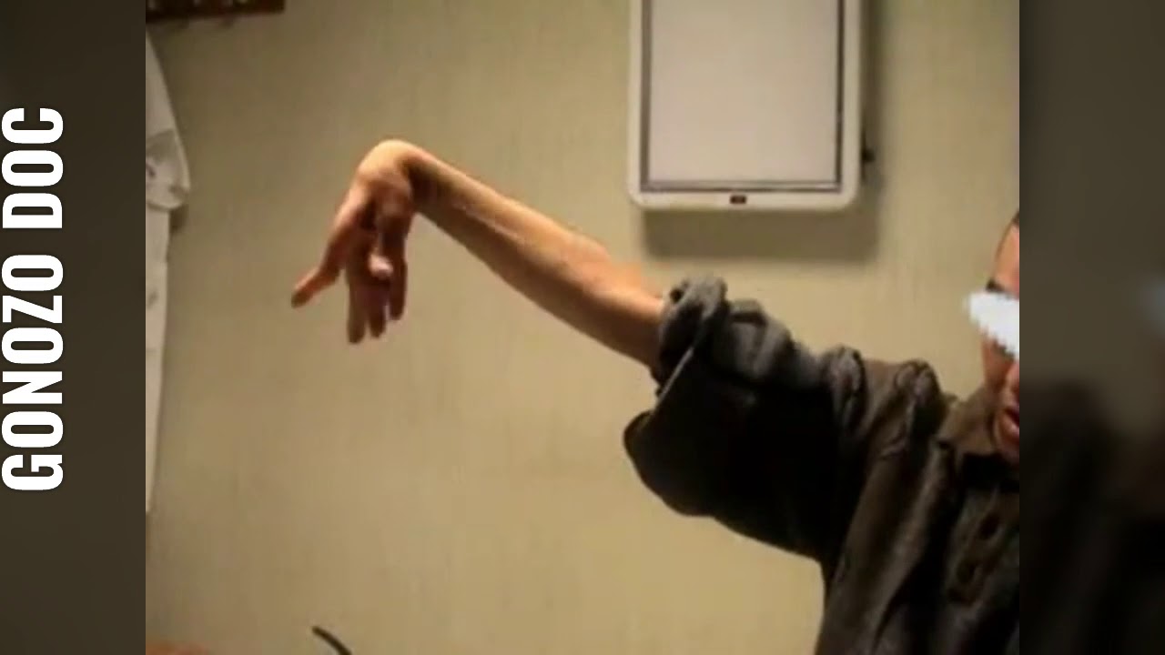 Athétose : mouvement anormal