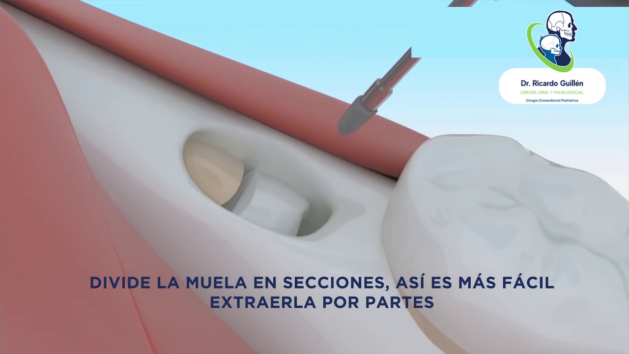 Extracci&oacute;n de Terceros Molares (Muelas del Juicio)