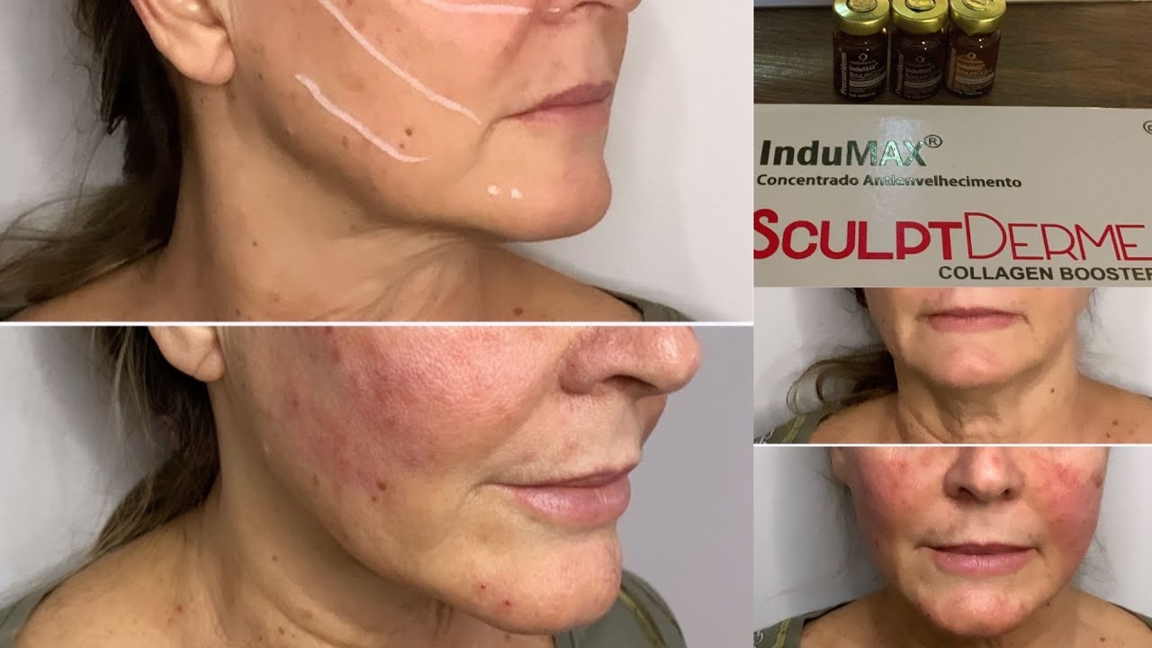 Protocolo Sculptderme Facial | Bioestimulador na Pressurizada