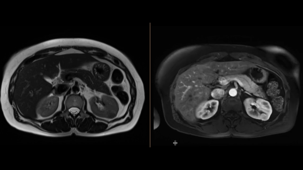Renal Oncocytoma