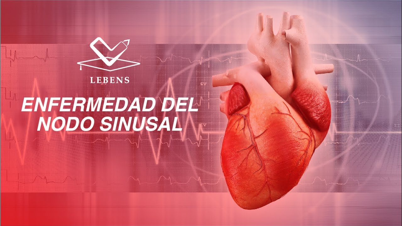 ENFERMEDAD DEL NODO SINUSAL
