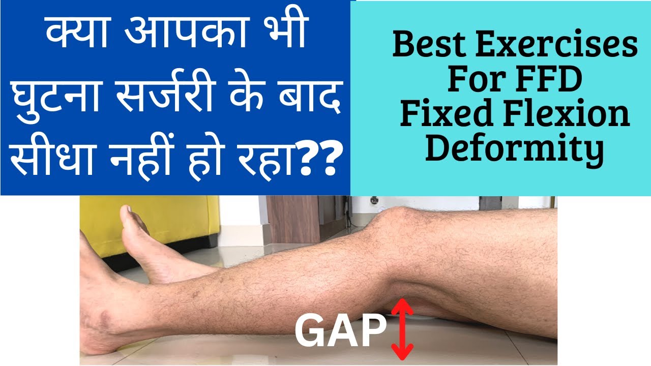 Best Exercises For Fixed Flexion Deformity | FFD | Bend Knee After Surgery | Exercises For Knee Pain